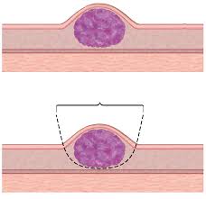 doctores, cirujano, cirujanos, doctoras, cirujano gastrointestinal, cirujano gastrointestinal y laparoscopia, cirujano general, laparoscopía, cirugia, hernias, hernias inguinales, vesícula, vesicula, hemorroides, fisuras anales, apendicectomía, apendicectomia, biopsias, cancer de mama, mastectomia, cáncer de mama, mastectomía, cirugía Conservadora de mama, cirugía Conservadora de mama, ganglio Centinela, seguimiento en cancer de mama, seguimiento en cáncer de mama, check up de la mujer, escleroterapia, úlceras, ulceras, heridas, apendicitis, piedras en vesicula, piedras en riñones, lipomas, doctores slp, cirujano slp, cirujanos slp, doctoras slp, cirujano gastrointestinal slp, cirujano gastrointestinal y laparoscopia slp, cirujano general slp, laparoscopía slp, cirugia slp, hernias slp, hernias inguinales slp, vesícula slp, vesicula slp, hemorroides slp, fisuras anales slp, apendicectomía slp, apendicectomia slp, biopsias slp, cancer de mama slp, mastectomia slp, cáncer de mama slp, mastectomía slp, cirugía Conservadora de mama slp, cirugía Conservadora de mama slp, ganglio Centinela slp, seguimiento en cancer de mama slp, seguimiento en cáncer de mama slp, check up de la mujer slp, escleroterapia slp, úlceras slp, ulceras slp, heridas slp, apendicitis slp, piedras en vesicula slp, piedras en riñones slp, lipomas slp, doctores san luis potosi, cirujano san luis potosi, cirujanos san luis potosi, doctoras san luis potosi, cirujano gastrointestinal san luis potosi, cirujano gastrointestinal y laparoscopia san luis potosi, cirujano general san luis potosi, laparoscopía san luis potosi, cirugia san luis potosi, hernias san luis potosi, hernias inguinales san luis potosi, vesícula san luis potosi, vesicula san luis potosi, hemorroides san luis potosi, fisuras anales san luis potosi, apendicectomía san luis potosi, apendicectomia san luis potosi, biopsias san luis potosi, cancer de mama san luis potosi, mastectomia san luis potosi, cáncer de mama san luis potosi, mastectomía san luis potosi, cirugía Conservadora de mama san luis potosi, cirugía Conservadora de mama san luis potosi, ganglio Centinela san luis potosi, seguimiento en cancer de mama san luis potosi, seguimiento en cáncer de mama san luis potosi, check up de la mujer san luis potosi, escleroterapia san luis potosi, úlceras san luis potosi, ulceras san luis potosi, heridas san luis potosi, apendicitis san luis potosi, piedras en vesicula san luis potosi, piedras en riñones san luis potosi, lipomas san luis potosi, doctores san luis potosí, cirujano san luis potosí, cirujanos san luis potosí, doctoras san luis potosí, cirujano gastrointestinal san luis potosí, cirujano gastrointestinal y laparoscopia san luis potosí, cirujano general san luis potosí, laparoscopía san luis potosí, cirugia, hernias san luis potosí, hernias inguinales san luis potosí, vesícula san luis potosí, vesicula san luis potosí, hemorroides san luis potosí, fisuras anales san luis potosí, apendicectomía san luis potosí, apendicectomia san luis potosí, biopsias san luis potosí, cancer de mama san luis potosí, mastectomia san luis potosí, cáncer de mama san luis potosí, mastectomía san luis potosí, cirugía Conservadora de mama san luis potosí, cirugía Conservadora de mama san luis potosí, ganglio Centinela san luis potosí, seguimiento en cancer de mama san luis potosí, seguimiento en cáncer de mama san luis potosí, check up de la mujer san luis potosí, escleroterapia san luis potosí, úlceras, ulceras san luis potosí, heridas san luis potosí, apendicitis san luis potosí, piedras en vesicula san luis potosí, piedras en riñones san luis potosí, lipomas san luis potosí,