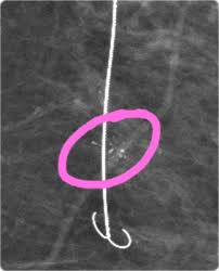 doctores, cirujano, cirujanos, doctoras, cirujano gastrointestinal, cirujano gastrointestinal y laparoscopia, cirujano general, laparoscopía, cirugia, hernias, hernias inguinales, vesícula, vesicula, hemorroides, fisuras anales, apendicectomía, apendicectomia, biopsias, cancer de mama, mastectomia, cáncer de mama, mastectomía, cirugía Conservadora de mama, cirugía Conservadora de mama, ganglio Centinela, seguimiento en cancer de mama, seguimiento en cáncer de mama, check up de la mujer, escleroterapia, úlceras, ulceras, heridas, apendicitis, piedras en vesicula, piedras en riñones, lipomas, doctores slp, cirujano slp, cirujanos slp, doctoras slp, cirujano gastrointestinal slp, cirujano gastrointestinal y laparoscopia slp, cirujano general slp, laparoscopía slp, cirugia slp, hernias slp, hernias inguinales slp, vesícula slp, vesicula slp, hemorroides slp, fisuras anales slp, apendicectomía slp, apendicectomia slp, biopsias slp, cancer de mama slp, mastectomia slp, cáncer de mama slp, mastectomía slp, cirugía Conservadora de mama slp, cirugía Conservadora de mama slp, ganglio Centinela slp, seguimiento en cancer de mama slp, seguimiento en cáncer de mama slp, check up de la mujer slp, escleroterapia slp, úlceras slp, ulceras slp, heridas slp, apendicitis slp, piedras en vesicula slp, piedras en riñones slp, lipomas slp, doctores san luis potosi, cirujano san luis potosi, cirujanos san luis potosi, doctoras san luis potosi, cirujano gastrointestinal san luis potosi, cirujano gastrointestinal y laparoscopia san luis potosi, cirujano general san luis potosi, laparoscopía san luis potosi, cirugia san luis potosi, hernias san luis potosi, hernias inguinales san luis potosi, vesícula san luis potosi, vesicula san luis potosi, hemorroides san luis potosi, fisuras anales san luis potosi, apendicectomía san luis potosi, apendicectomia san luis potosi, biopsias san luis potosi, cancer de mama san luis potosi, mastectomia san luis potosi, cáncer de mama san luis potosi, mastectomía san luis potosi, cirugía Conservadora de mama san luis potosi, cirugía Conservadora de mama san luis potosi, ganglio Centinela san luis potosi, seguimiento en cancer de mama san luis potosi, seguimiento en cáncer de mama san luis potosi, check up de la mujer san luis potosi, escleroterapia san luis potosi, úlceras san luis potosi, ulceras san luis potosi, heridas san luis potosi, apendicitis san luis potosi, piedras en vesicula san luis potosi, piedras en riñones san luis potosi, lipomas san luis potosi, doctores san luis potosí, cirujano san luis potosí, cirujanos san luis potosí, doctoras san luis potosí, cirujano gastrointestinal san luis potosí, cirujano gastrointestinal y laparoscopia san luis potosí, cirujano general san luis potosí, laparoscopía san luis potosí, cirugia, hernias san luis potosí, hernias inguinales san luis potosí, vesícula san luis potosí, vesicula san luis potosí, hemorroides san luis potosí, fisuras anales san luis potosí, apendicectomía san luis potosí, apendicectomia san luis potosí, biopsias san luis potosí, cancer de mama san luis potosí, mastectomia san luis potosí, cáncer de mama san luis potosí, mastectomía san luis potosí, cirugía Conservadora de mama san luis potosí, cirugía Conservadora de mama san luis potosí, ganglio Centinela san luis potosí, seguimiento en cancer de mama san luis potosí, seguimiento en cáncer de mama san luis potosí, check up de la mujer san luis potosí, escleroterapia san luis potosí, úlceras, ulceras san luis potosí, heridas san luis potosí, apendicitis san luis potosí, piedras en vesicula san luis potosí, piedras en riñones san luis potosí, lipomas san luis potosí,